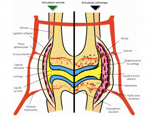 Qu'est-ce que l'ostéoarthrose?